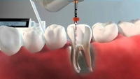 Endodoncia
